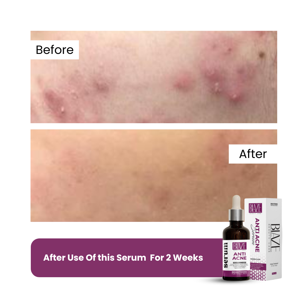 Anti-Acne | Clarifying Serum