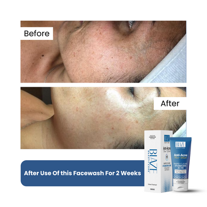 Anti-Acne Face Wash